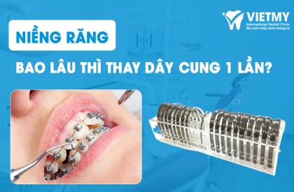 Thời Gian Thay Dây Cung Trong Quá Trình Niềng Răng Là Bao Lâu?